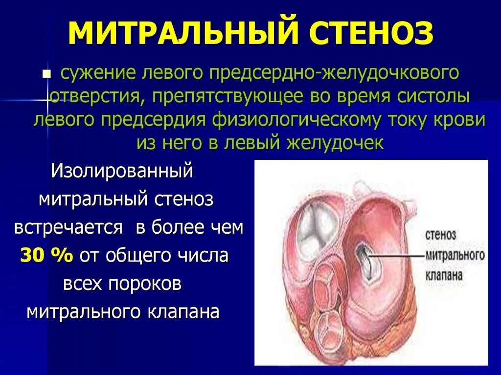 Пороки сердца стенозы клапанов. Пороки сердца стенозы клапанов недостаточность клапанов. Приобретённые пороки сердца недостаточность митрального клапана. Пороки сердца стеноз митрального клапана. Клапан правого предсердно желудочкового отверстия