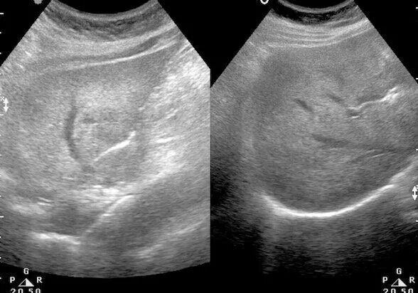 Неоднородная паренхима печени УЗИ. Паренхима диффузно неоднородная. Паренхима печени по УЗИ. Паренхима печени диффузно изменена.