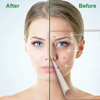 Acne removing
