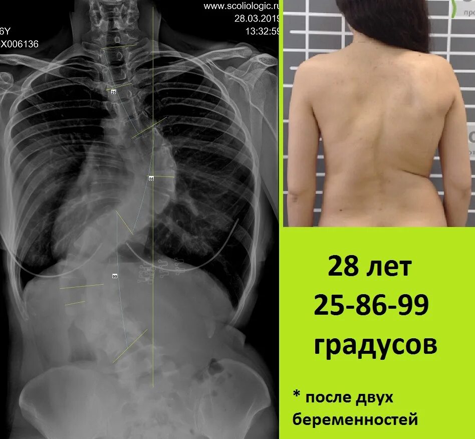 Искривление позвоночника градусы. Сколиоз 2 степени рентген. Сколиоз 2 степени рентген 17 градусов. Искривление позвоночника 20 градусов. Искривление позвоночника 12 градусов.