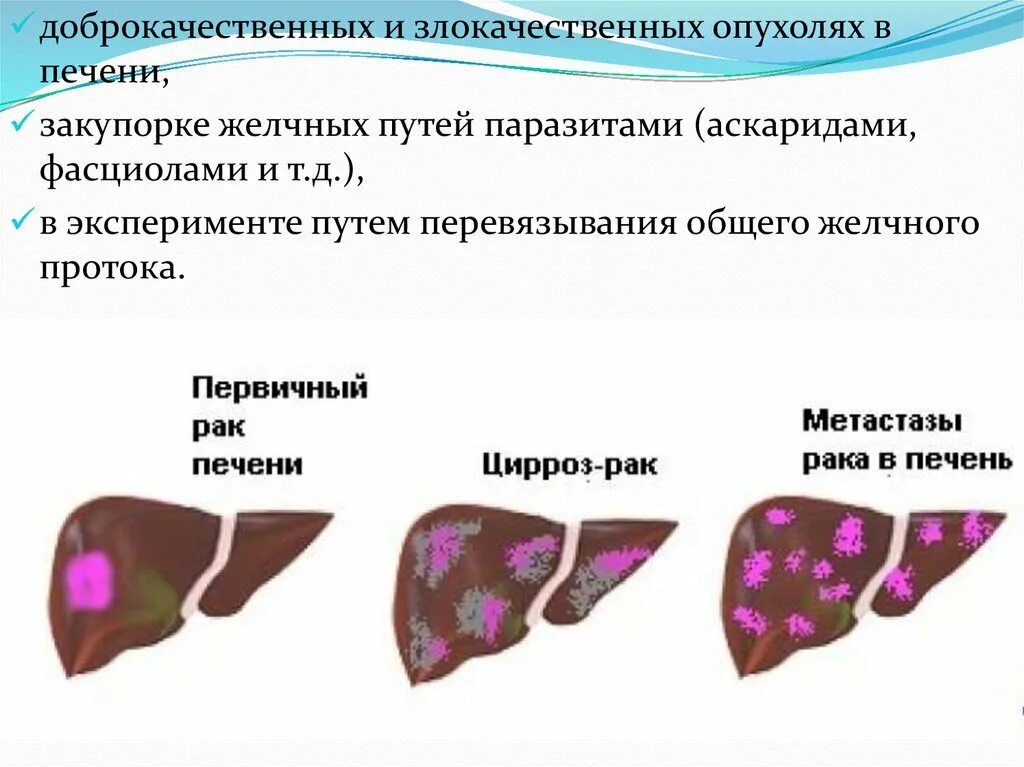 Округлое образование печени. Объемные образования печени. Новообразование в печени. Доброкачественные опухоли печени.