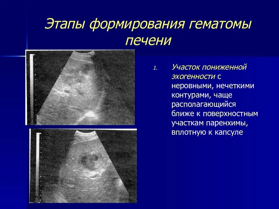 Подкапсулярная гематома печени. Этапы развития гематомы.