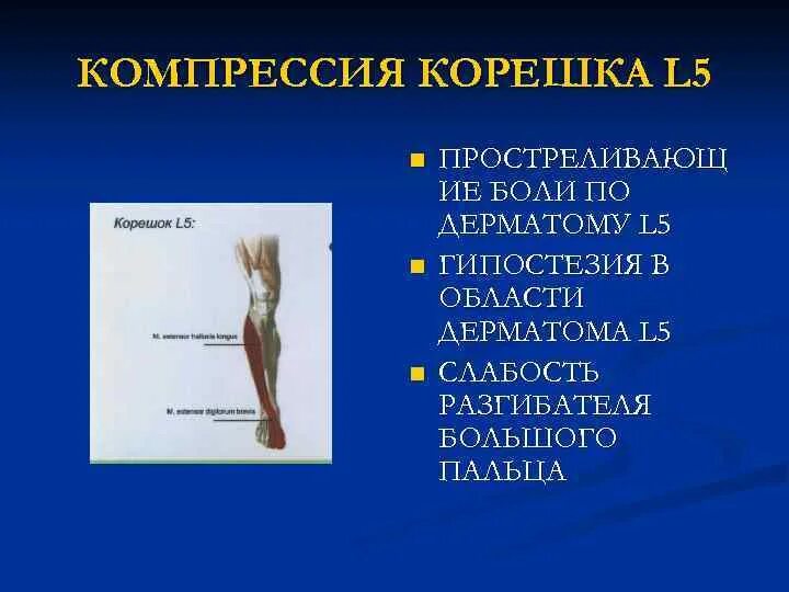 Радикулопатия справа. Симптомы компрессии Корешков l4. Радикулопатия s1 Корешков. Синдром компрессии корешка l5. Компрессионно корешковый синдром l5-s1.