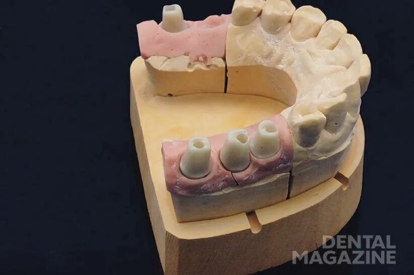 Изготовление гипсовой модели. Разборная модель пиндекс система. Разборная гипсовая модель. Разборная модель зуботехническая. Разборная модель в стоматологии.