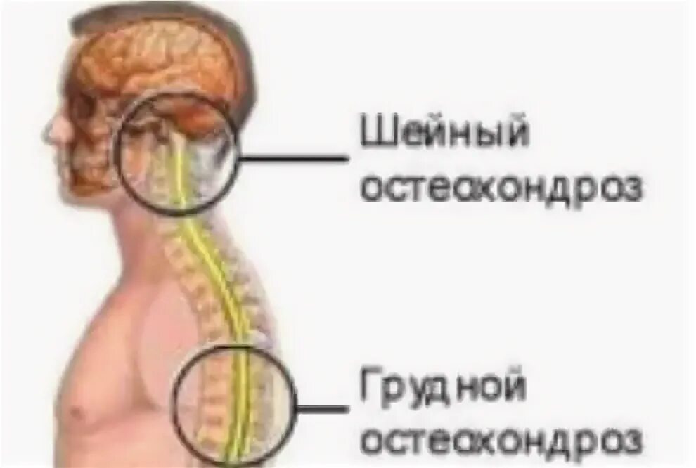 Ощущение при шейном остеохондрозе