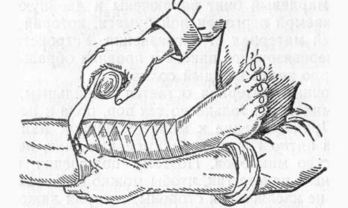 Зачем перед операцией бинтуют. Хирургические перевязки. Перевязка ног перед операцией. Бинтование конечностей перед операцией. Бинтование ног перед операцией.