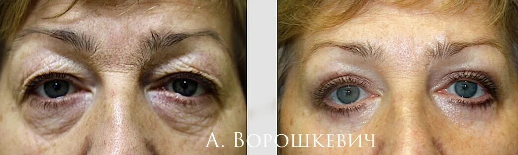 Глаза после круговой блефаропластики. Блефаропластика после травмы. ассиметрия век до и после блефаропластики. камуфляж век после блефаропластики.