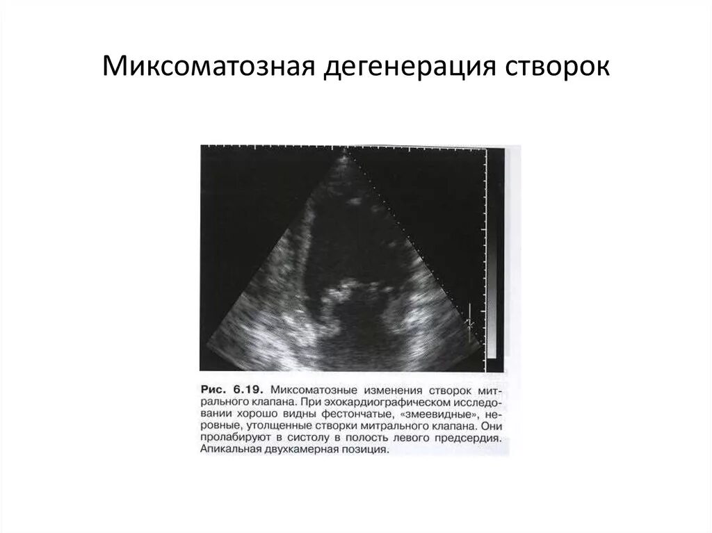 Миксоматозная дегенерация. Миксоматоз створок митрального клапана на УЗИ. Миксоматозная дегенерация митрального клапана на УЗИ. Миксоматозный пролапс митрального кла. Миксома створок митрального клапана.