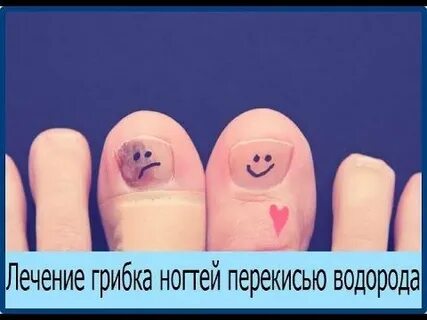 Перекись водорода ногти на ногах