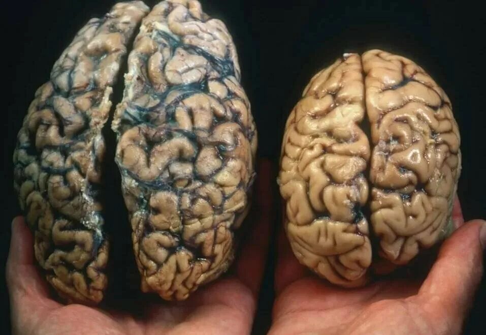 Large brain. Размер мозга человека. Мозг усного и глубого человека.