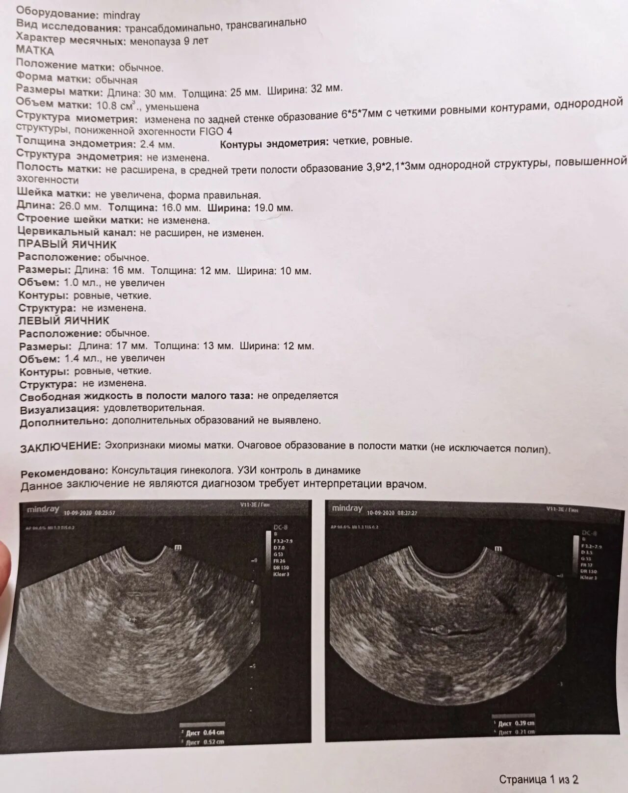 Можно забеременеть с полипом в матке. Расширение полости матки на УЗИ. Образования в полости матки на УЗИ. Расширенная полость матки на УЗИ.