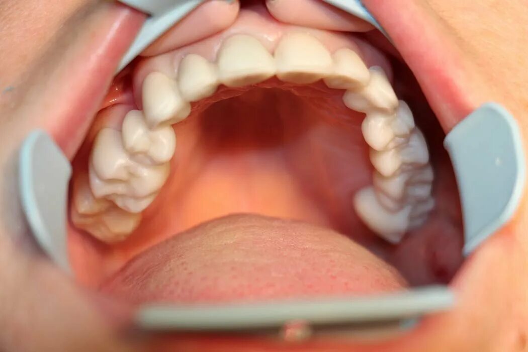 Коронки на передние губы. Привыкание к съемным зубным протезам. Протезы в ортопедической стоматологии. Полносъемные протезы зубные. Съемный протез (3-5 зубов) термо джет.