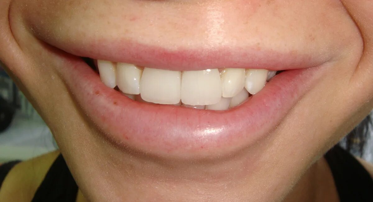 Винир прямой композитный. Прямые композитные виниры. материал для композитных виниров.