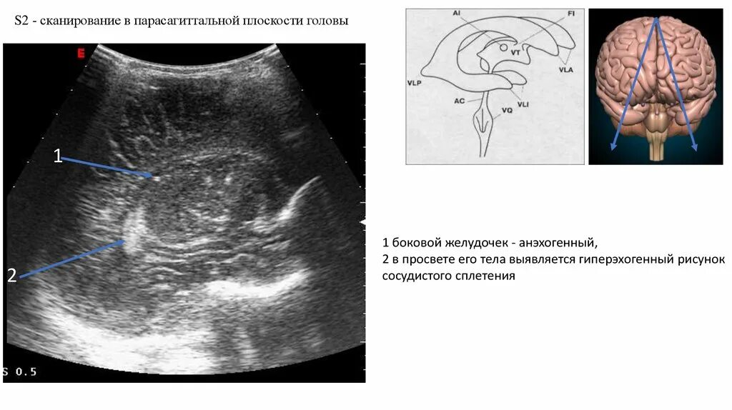 УЗИ головного мозга нейросонография. НСГ срезы УЗИ. НСГ боковые желудочки. УЗИ анатомия НСГ.