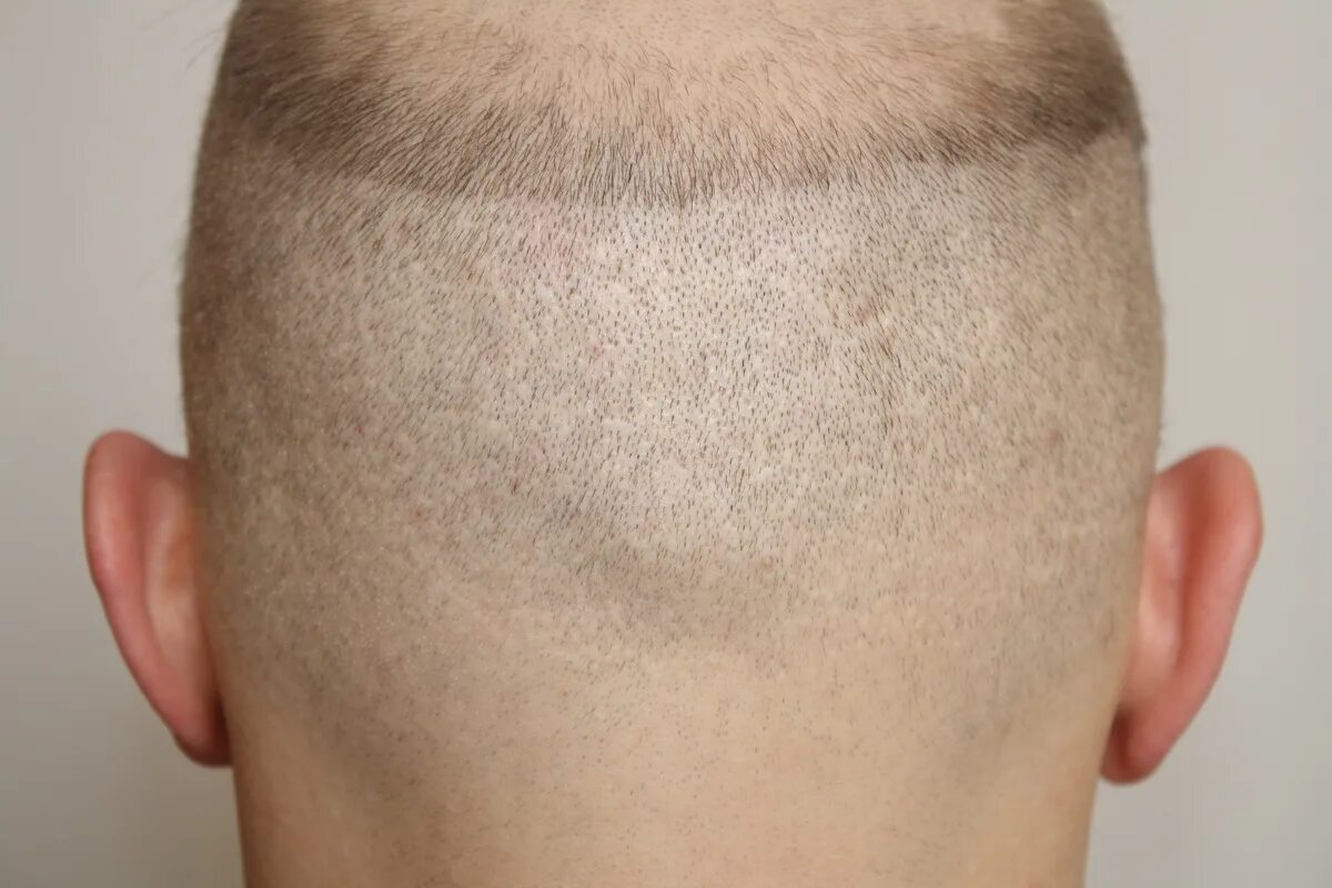 Пересадка волос цена для мужчин 2024. Трансплантация волос на голове. Бесшовный метод пересадки волос.