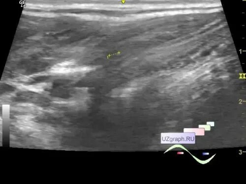 Обучение узи ultrasonicthyroid ru. Презентация интересного случаи на УЗИ. Стеатонекрозы как выглядит.