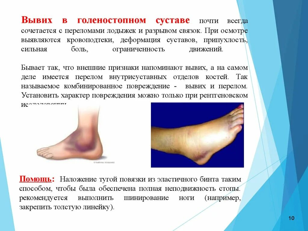 Перенапряжение голеностопного сустава. Вывих голеностопного сустава. Выверхголеностопного сустава. Растяжение голеностопного сустава. Разрыв связок голеностопного сустава.