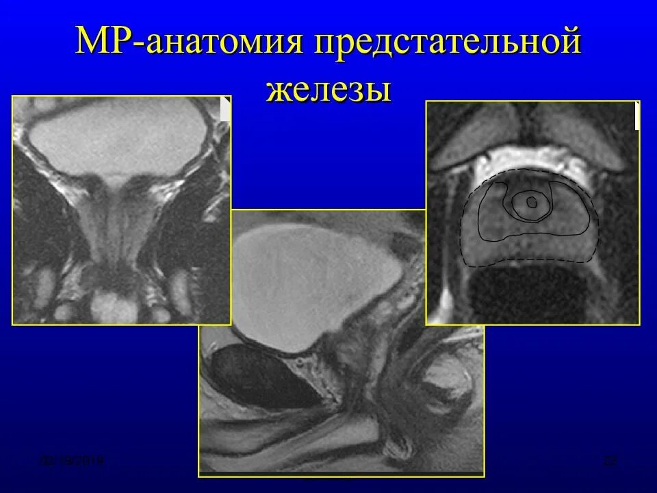 Аденома простаты мрт. Зональная анатомия предстательной железы мрт. Предстательная железа кт анатомия. Схема предстательной железы на мрт. Зоны предстательной железы мрт анатомия.