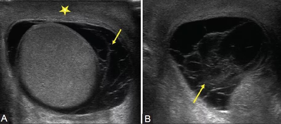 Осумкованное гидроцеле на УЗИ. Киста придатка яичка мрт. Водянка оболочек яичка УЗИ.