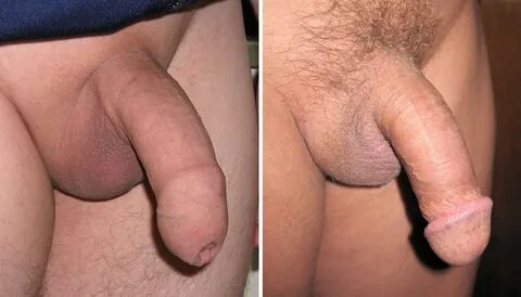 Файл:Uncircumcised and circumcised penis.JPG — Википедия.