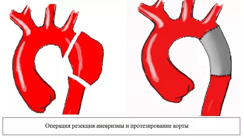После протезирования аорты. Операции при расслаивающей аневризме аорты. аневризмы грудной аорты хирургия. операции при расслаивающей аневризме дуги аорты. сосудистый протез аорты.