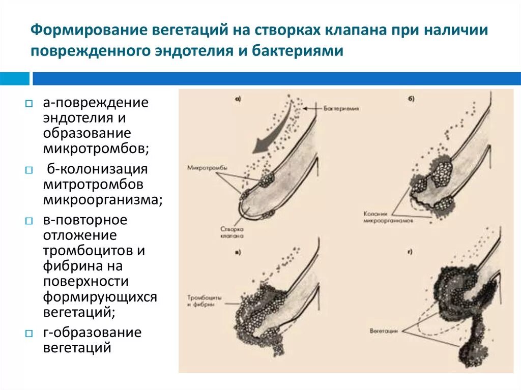 Вегетация определяется. Вегетации на створках клапанов. Вегетации на клапанах сердца. Вегетации на створках митрального клапана.