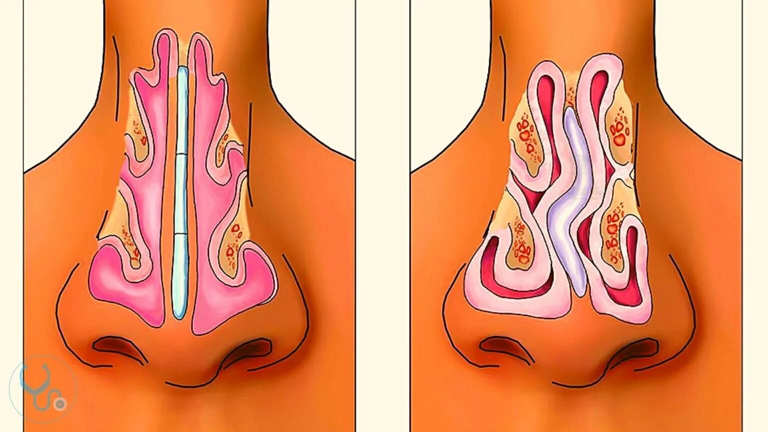 Искривление носовой перегородки операция схема. Перфорация носовой перегородки. Редрессация перегородки носа. Искривление носовой перегородки вазомоторный ринит. Шип носовой перегородки.
