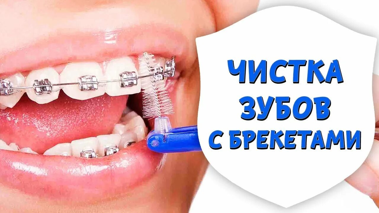 Как чистить зубы в брекетах. Проф гигиена с брекет системой. как правильно чистить зубы с брекетами.