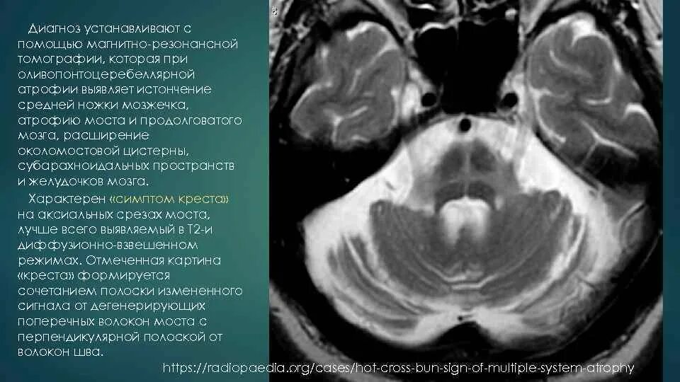 Атрофия головного мозга продолжительность. Оливопонтоцеребеллярная дегенерация мрт. Мультисистемная атрофия мрт. Мультисистемная атрофия головного мозга на мрт. Атрофия мозжечка кт мрт.