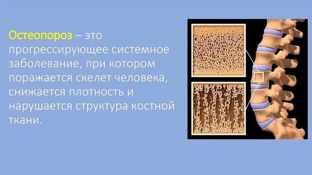 Лечение костных заболеваний. Остеопороз. Прогрессирующий остеопороз. Системные заболевания костей.