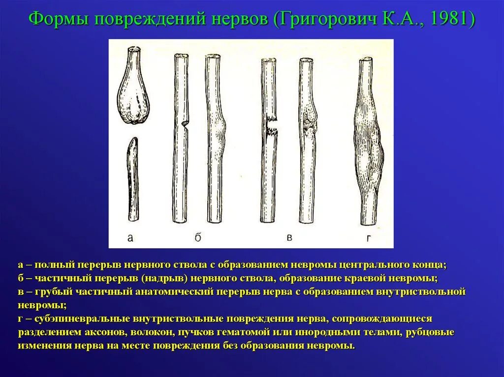 Травмы периферических нервов. Виды повреждения нервов.