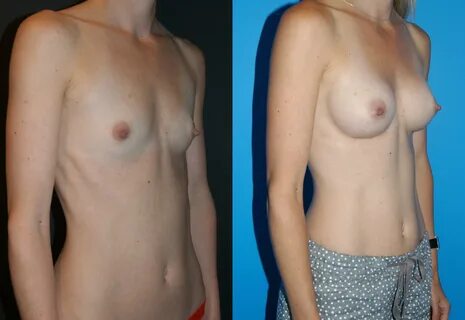 Breast enlarge surgery - Nude pics.