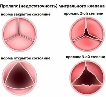 Пролапс передней стенки