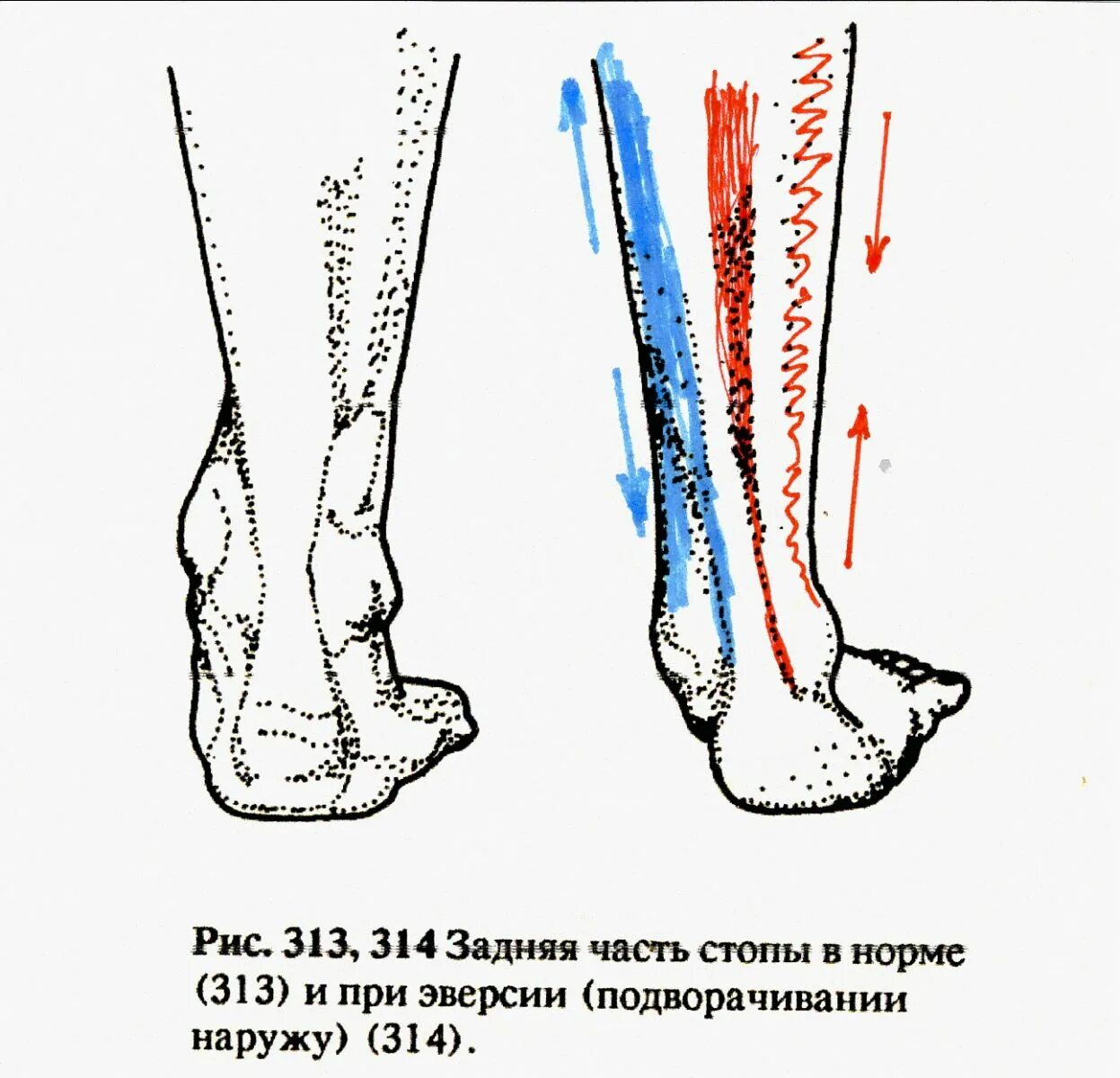 Вальгусная стопа у взрослых операция. Плоско вальгусная деформация стопы плоскостопие. Вальгус стопы это плоскостопие. Вальгусная деформация голеностопа. Вальгусная деформация оси конечности.