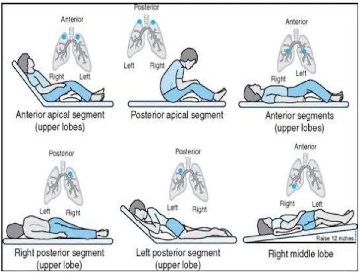 Постуральный дренаж при бронхоэктатической болезни. Позиционный дренаж Постуральный дренаж. Дренажные положения для отхождения мокроты. Постуральный дренаж 4 положения. Постуральный массаж