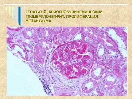 Почечный гепатит