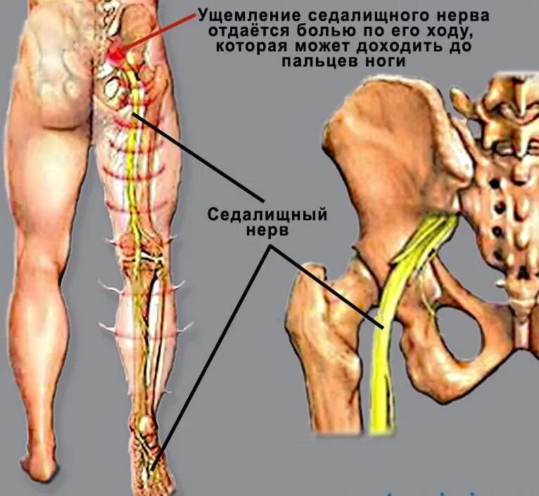 Болит нога после операции грыжи позвоночника. Анатомия седалищного нерва у человека. Седалищный нерв схема. Где находится седалищный нерв у человека фото. Седалищный и бедренный нерв.