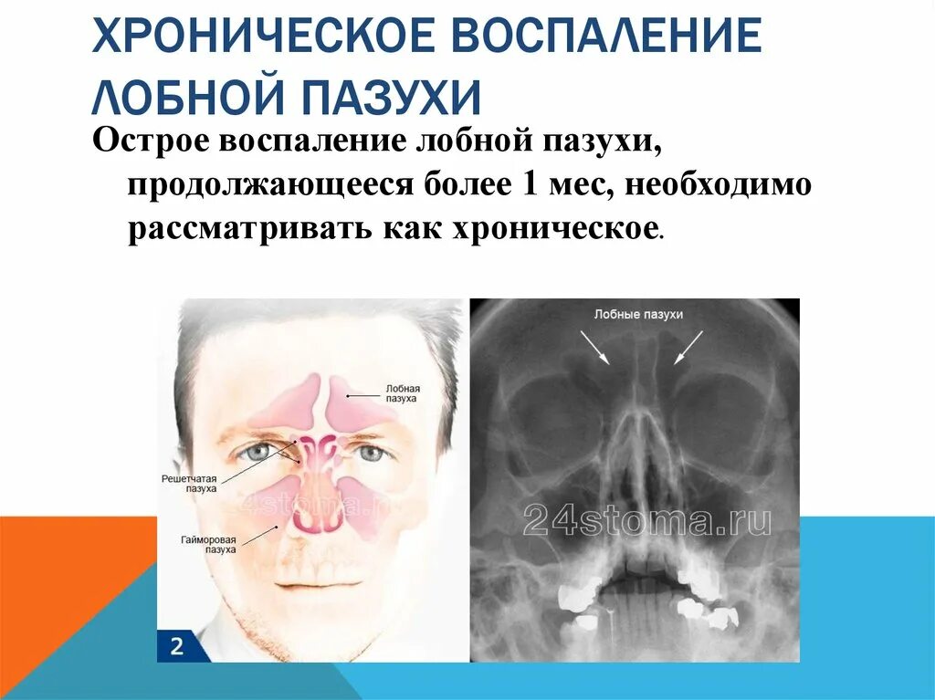 Болезни носа и придаточных. Синусит гайморит фронтит. Этмоидит сфеноидит фронтит. Острый фронтальный синусит симптомы. Синусит придаточных пазух.