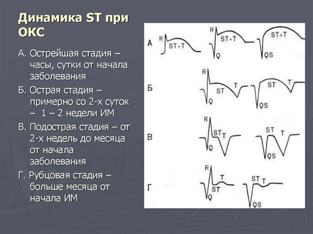 Инфаркт без подъема сегмента st. Окс c подъемом сегмента st экг. острый коронарный синдром с подъемом сегмента st экг. экг при остром коронарном синдроме. окс с подъёмом st экг признаки.