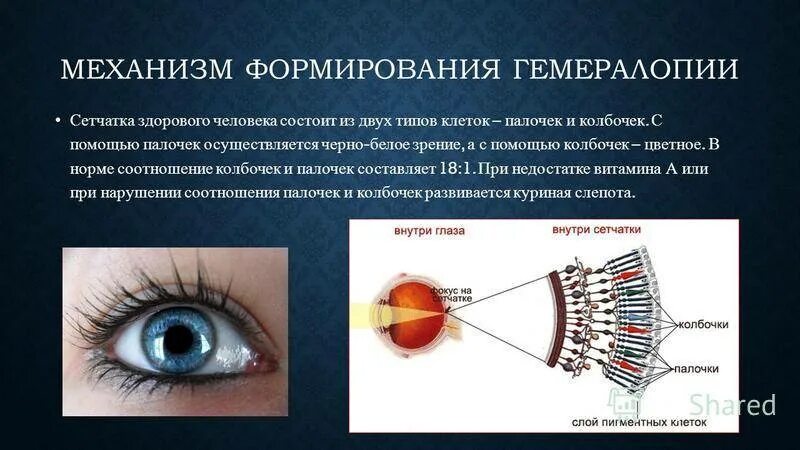 Заболевание куриная слепота витамины. Гемералопия (куриная слепота). Куриная слепота заболевание глаз. Куриная слепота — расстройство сумеречного зрения..
