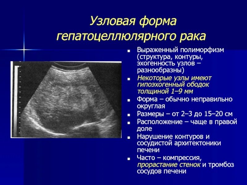 Эхогенность селезенки. Гепатоцеллюлярная карцинома печени на УЗИ. Фокальная нодулярная гиперплазия печени на УЗИ. Узловая гиперплазия печени на УЗИ. УЗИ признаки опухоли печени.