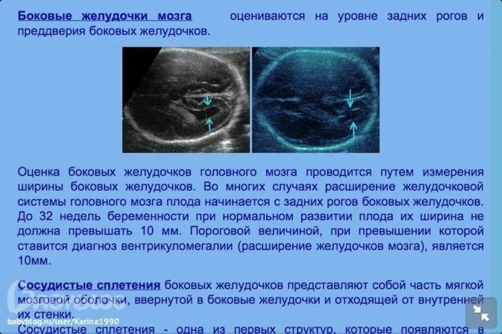 Желудочки мозга плода расширены. Расширение боковых желудочков головного мозга на кт. Вентрикуломегалия узи. Расширение боковых желудочков головного мозга. Желудочки мозга плода расширены.