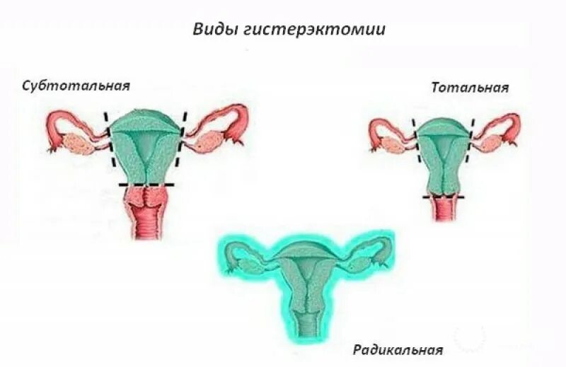 Влагалищная гистерэктомия. Экстирпация и ампутация матки разница. Экстирпация матки с придатками. Гистерэктомия что это такое простыми