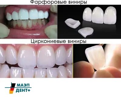 Разница между винирами и коронками