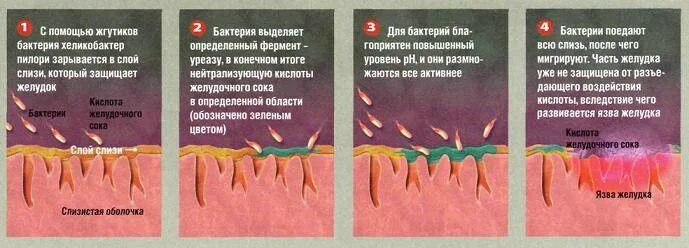 Заболевание хеликобактер симптомы. Хеликобактер пилори патогенез язвенной болезни. лекарство от язвы желудка хеликобактер пилори. патогенез язвенной болезни желудка хеликобактер. патогенез гастрита хеликобактер пилори.