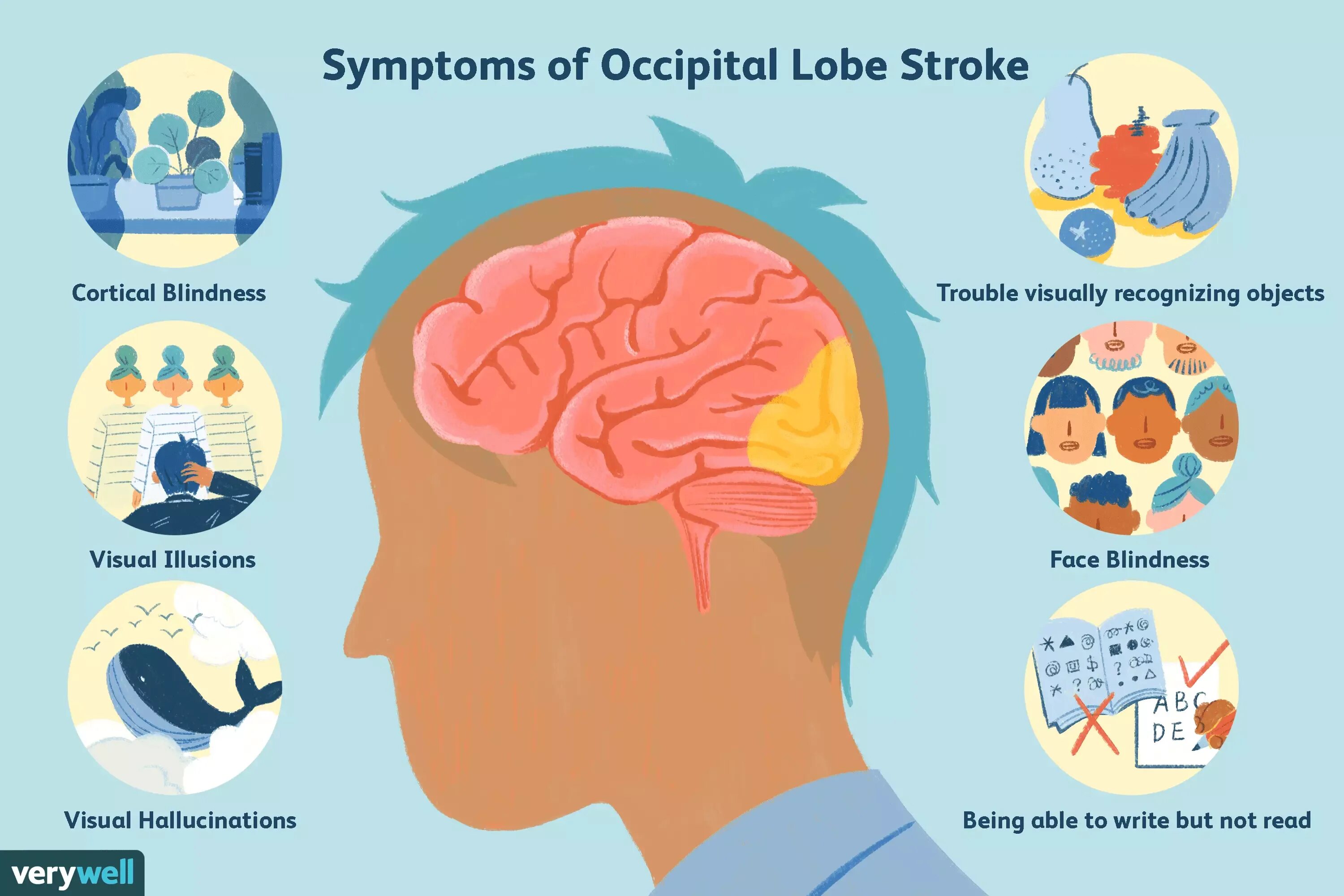 Инсульт в затылочной доле. Occipital Lobe. Инсульт затылочной доли симптомы. Инсульт височной доли.