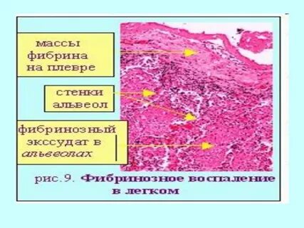 Зоны воспаления