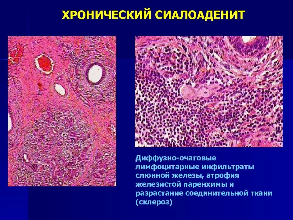 Лимфоидная инфильтрация что это. Сиалоаденит патологическая анатомия. Хронический паротит микропрепарат. Хронический интерстициальный сиалоаденит характеризуется. Инфильтрация патанатомия.