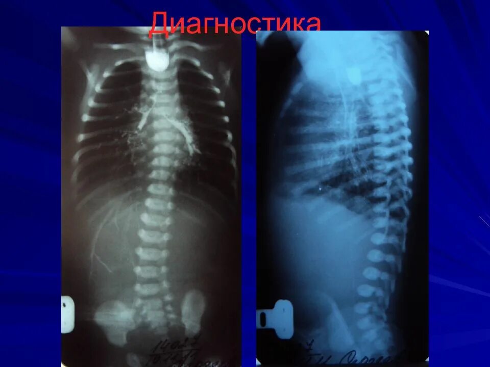 Атрезия пищевода. Атрезия пищевода рентген. безсвищевая форма атрезии пищевода. рентген при атрезии пищевода. атрезия пищевода без трахеопищеводного свища.