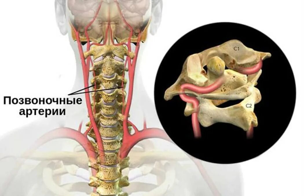 Кровоснабжение межпозвоночных дисков. Вертебральный синдром позвоночной артерии. Экстравазальная компрессия позвоночной артерии что это такое. Позвоночная артерия вертебральный канал. Синдром малой позвоночной артерии.